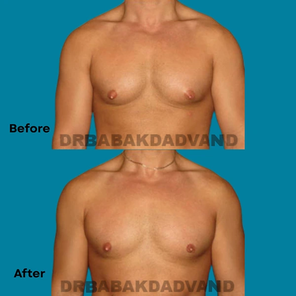 Male chest contouring before and after with gynecomastia surgery in Los Angeles area