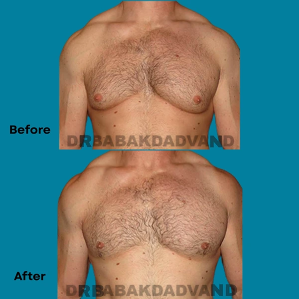 Gynecomastia surgery before and after showing improved male chest contour in Beverly Hills