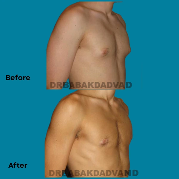 Male breast reduction before and after result by Dr. Babak Dadvand in Beverly Hills